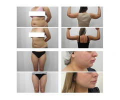 VASER Liposuction Clinic Sydney | Advanced Body Contouring Solutions