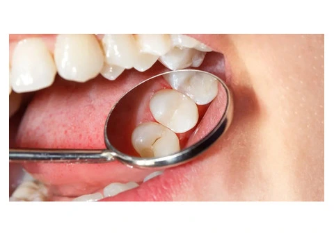 Learn About Dental Fillings from the Top Cosmetic Dentist Australia