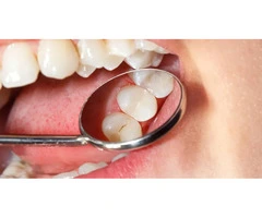 Learn About Dental Fillings from the Top Cosmetic Dentist Australia