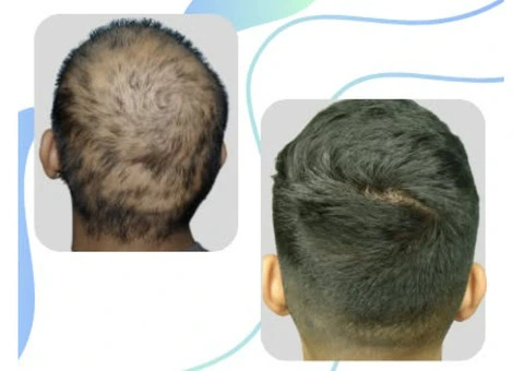 Success Stories in Effective Hair Treatment in Perth
