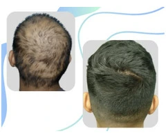 Success Stories in Effective Hair Treatment in Perth