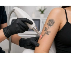 Safe & Effective Laser Tattoo Removal in Sydney