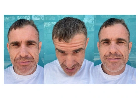 See Why Graham Trusted IHLS for Long-Term Hair Restoration