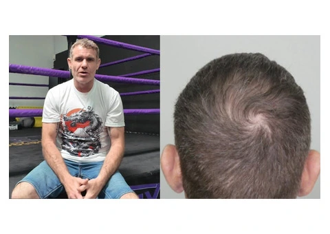 Regain Your Edge at a Leading Hair Loss Clinic in Perth