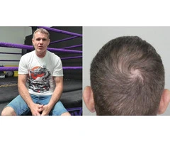Regain Your Edge at a Leading Hair Loss Clinic in Perth