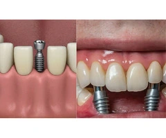 Tooth Restoration Implants for Permanent Smile Solutions