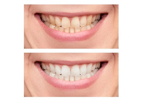 Teeth Bleaching Dentist for Yellow Teeth