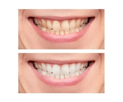 Teeth Bleaching Dentist for Yellow Teeth