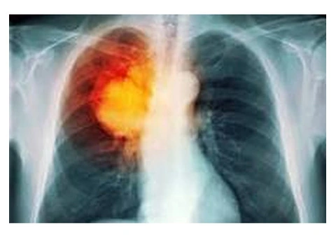 Lung Cancer Screening Wollert
