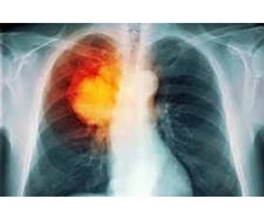 Lung Cancer Screening Wollert