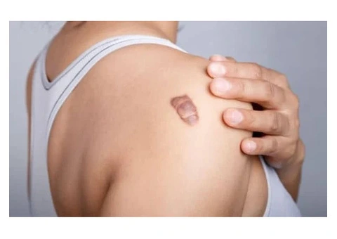 Support Smoother Skin with Keloid Bump Removal Services
