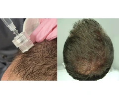Experience the Future of Hair Restoration with Exosome Therapy in Australia