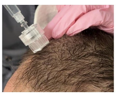 Top Benefits of Exosomes Hair Treatment in Perth