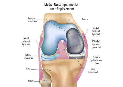 Move More Comfortably with Partial Knee Surgery