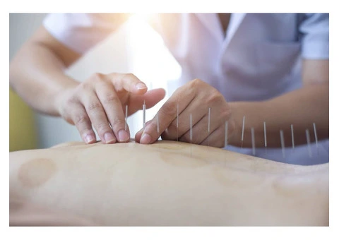Acupuncturist in Adelaide | Natural Pain Relief & Wellness Care