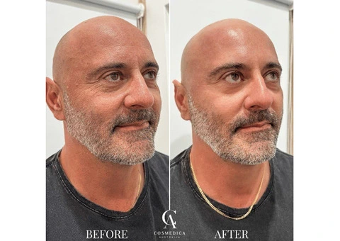 Hydra Facial Sydney