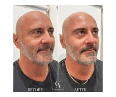 Hydra Facial Sydney