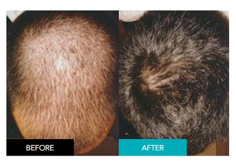 Get Natural Results with a Seamless Integrated Hair System For Men