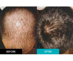 Get Natural Results with a Seamless Integrated Hair System For Men