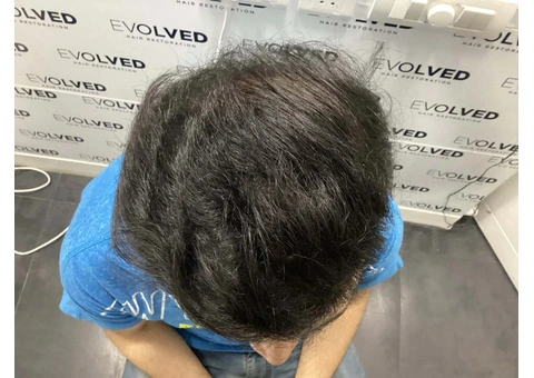 Get Natural Hair Growth with Expert Hair Transplant Services in Perth