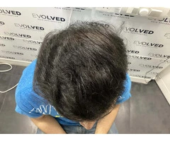 Get Natural Hair Growth with Expert Hair Transplant Services in Perth
