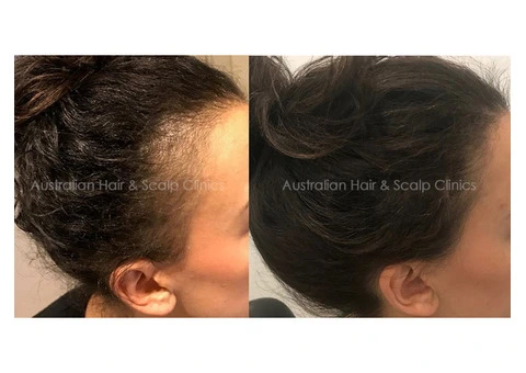 Female Hair Loss Solutions and Professional Guidance