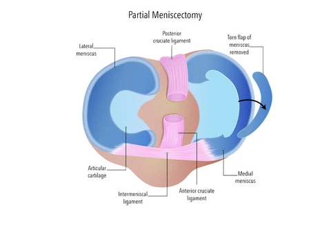 Find Practical Options for Osteoarthritis Treatment
