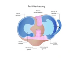 Find Practical Options for Osteoarthritis Treatment