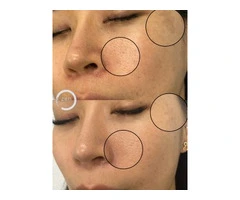Restore Skin Confidence with Advanced Skin Tightening