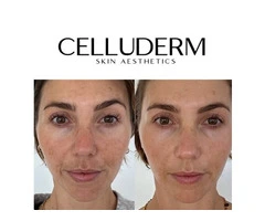 Skin Clinic St Kilda – Personalised Skin Treatments at CelluDerm
