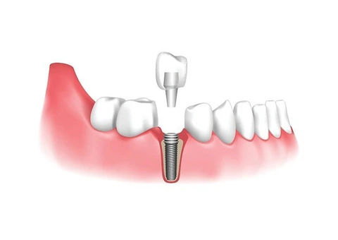 Permanent Tooth Replacement Using Modern Implant Technology