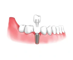 Permanent Tooth Replacement Using Modern Implant Technology