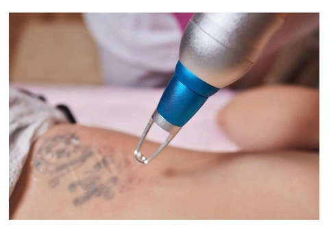 Best Laser Tattoo Removal in Sydney for Safe and Effective Results