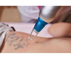 Best Laser Tattoo Removal in Sydney for Safe and Effective Results