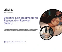Pigmentation Removal Sydney: Best Treatments for Clear Skin