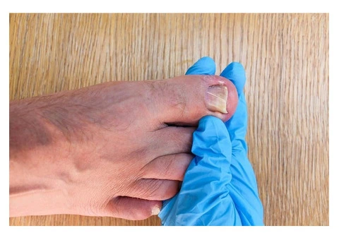 Get the Best Ingrown Toenail Treatment in Black Rock