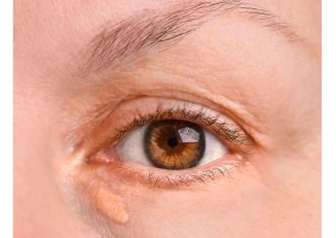 Support Clearer Eyelid Skin with Xanthelasma Removal Treatment