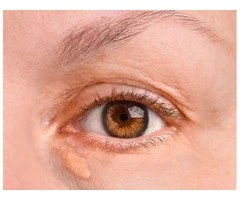 Support Clearer Eyelid Skin with Xanthelasma Removal Treatment