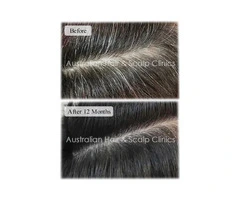 Hair Shaft Repair Treatment for Healthier Hair