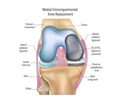 Partial Knee Replacement Surgery for Damaged Knee Compartments