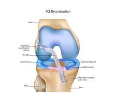 Torn ACL Surgery Begins with the Right Diagnosis