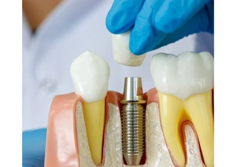 Tooth Implant Process Explained for Better Oral Health