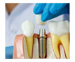 Tooth Implant Process Explained for Better Oral Health