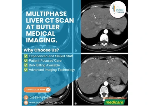 Multiphase Liver CT Scan at Butler Medical Imaging. (08) 9544 3999