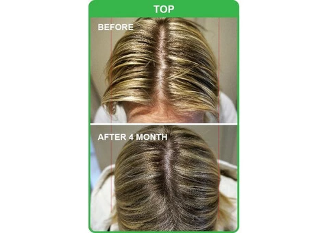 Natural and Effective Hair Loss Treatment in Adelaide