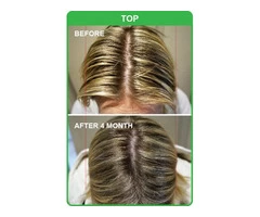 Natural and Effective Hair Loss Treatment in Adelaide