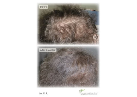 Looking for the Best Hair Loss Treatment in Sydney?