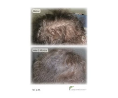 Looking for the Best Hair Loss Treatment in Sydney?