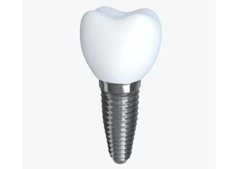 Get Best teeth implants in Melbourne | Prahran Family Dental - 1/3