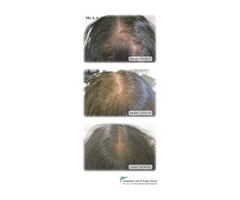 Looking for Hair Treatment in Adelaide?